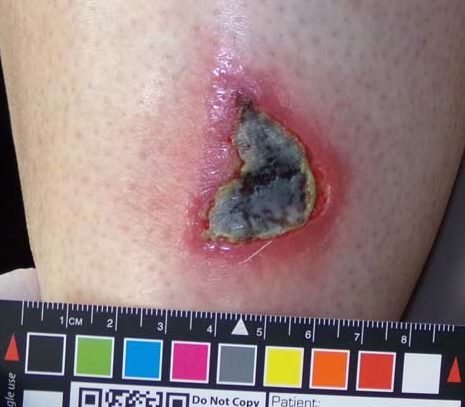 necrotic wound needing debridement, skin necrosis