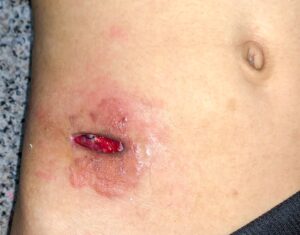 dehisced wound on abdomen