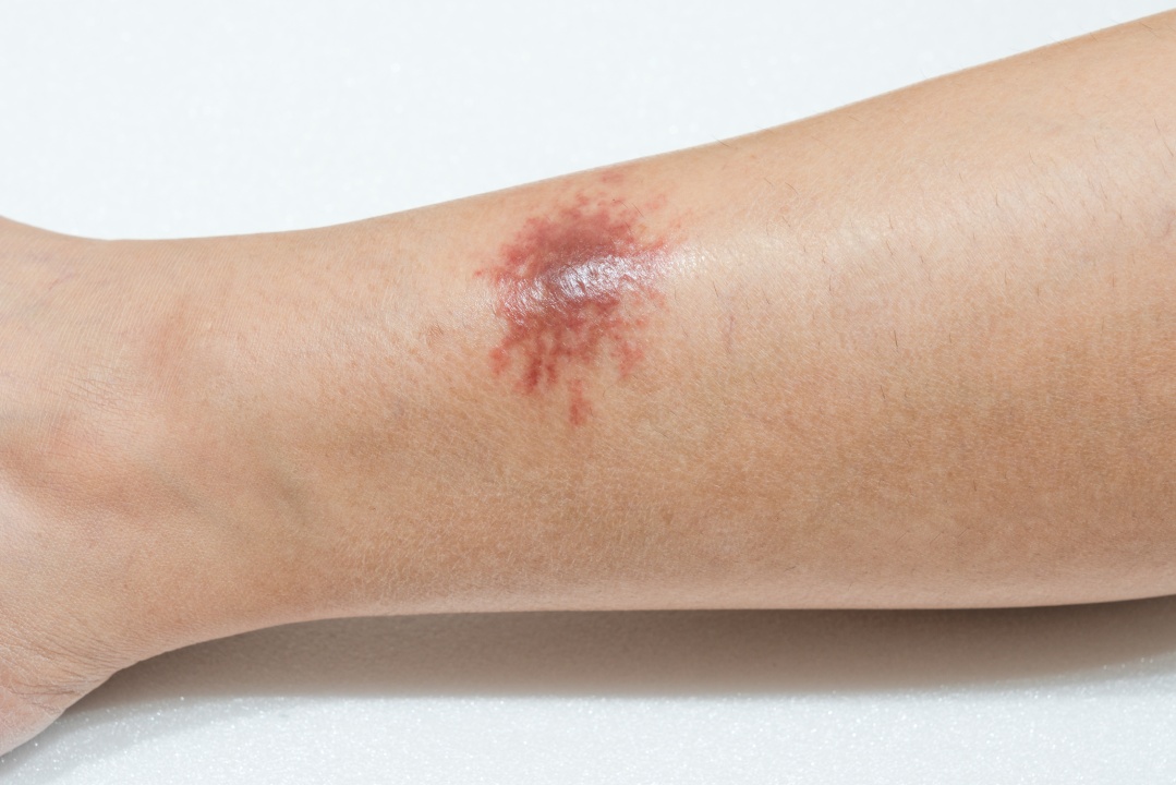 Necrotic Wound Treatment and Care