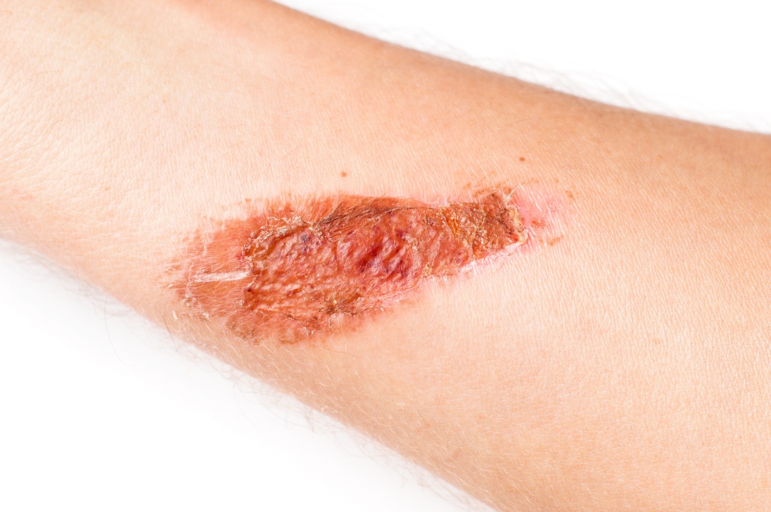Signs You Need Immediate Wound Care