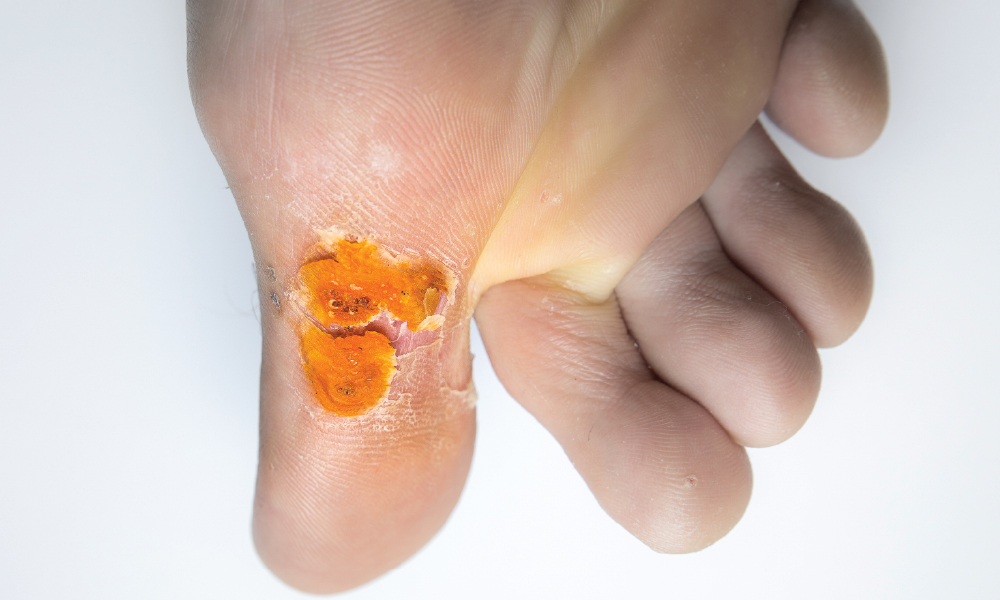Diabetic Foot Ulcers